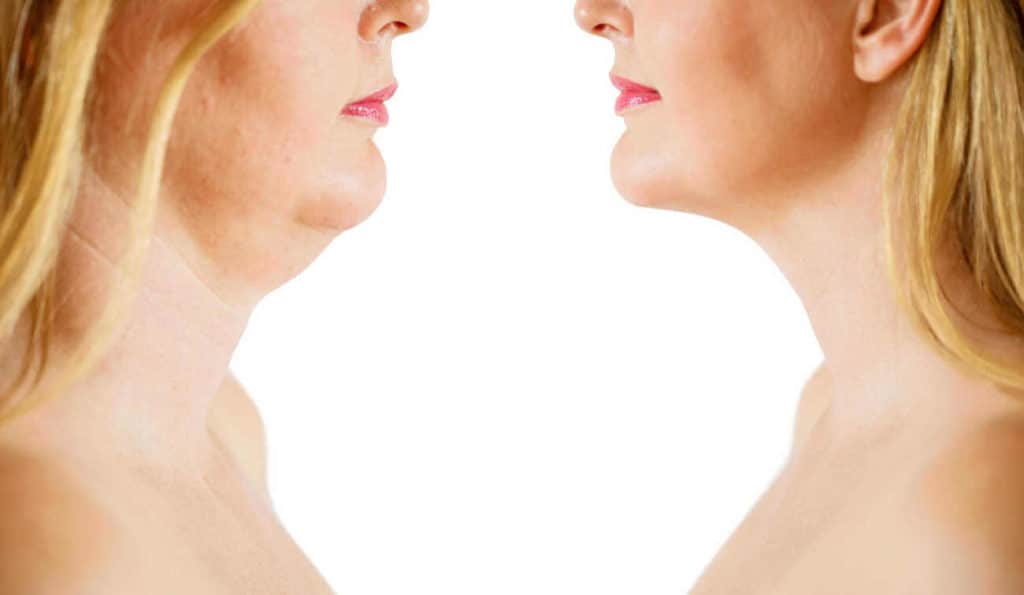 Double Chin treatment Tilbury before and after results