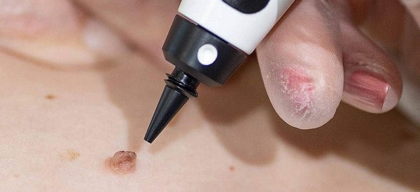 After Skin Tag Removal Tilbury