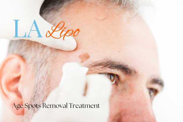What Are the Most Effective Treatments for Age Spots Tilbury?