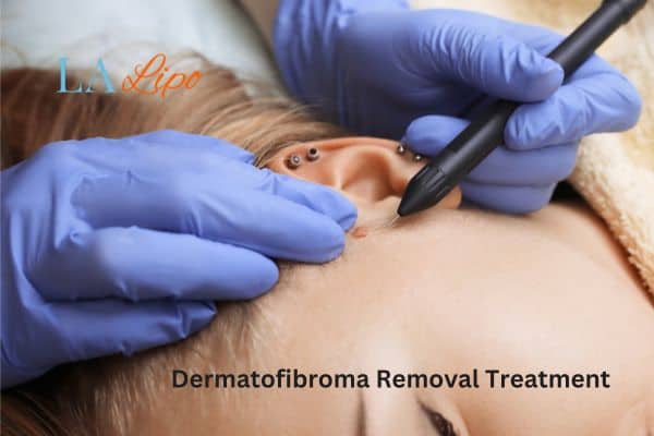 Dermatofibroma Removal Treatment Tilbury