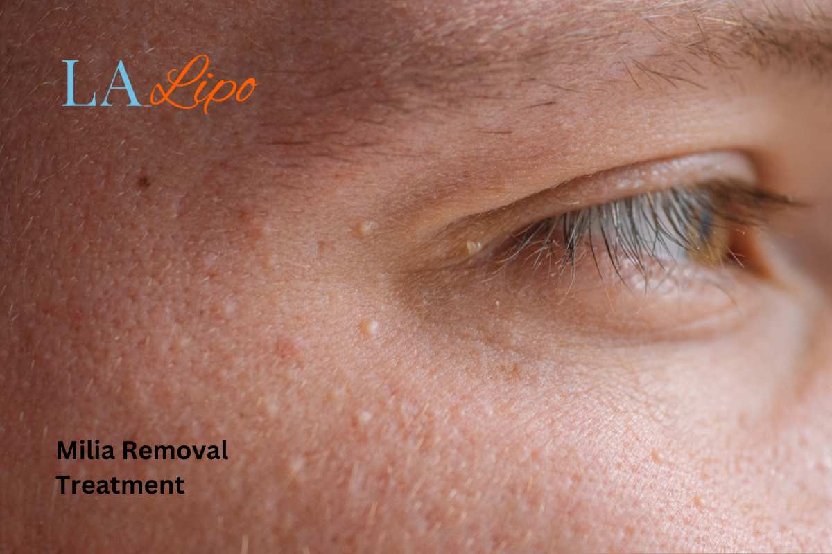 Cryopen Milia Removal: Is It the Easiest and Safest Option Tilbury?