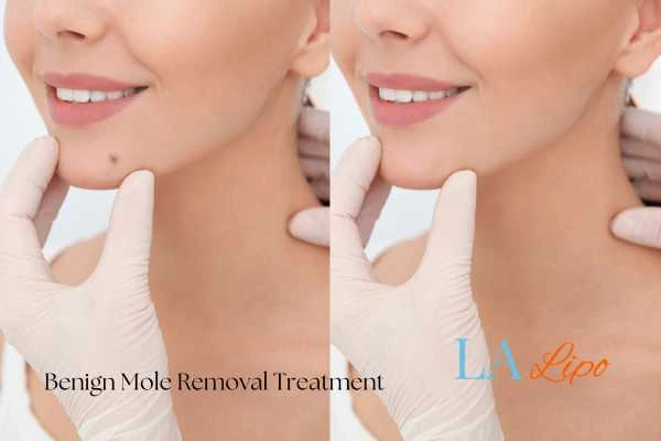 woman's before and after mole removal Tilbury results