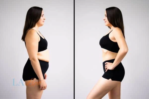 image of woman before and after results of LA-EMS Body Sculpting Tilbury to help treat Diastasis recti