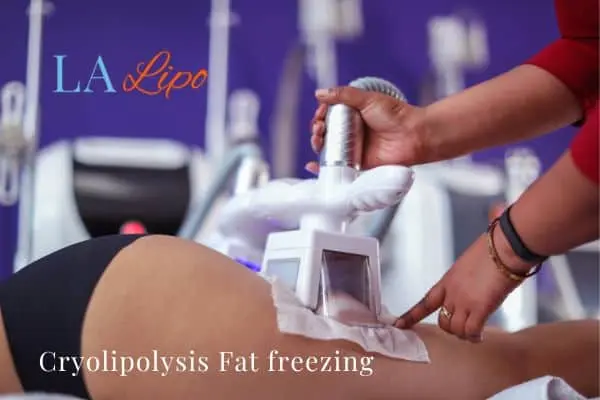 women getting fat freezing Tilbury