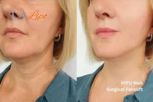 hi-fu for wrinkles Tilbury before and after results