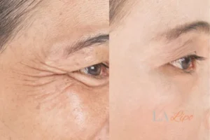 Before and after results of woman - HI-fu wrinkles reduction treatment Tilbury
