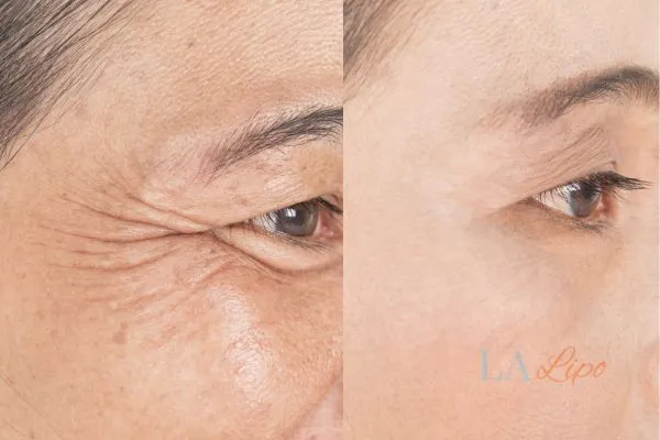 Before and after results of woman - HI-fu wrinkles reduction treatment Tilbury