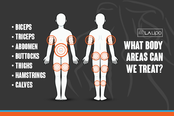 Graphic to show areas you can have LA-EMS Body Sculpting Tilbury treatment.