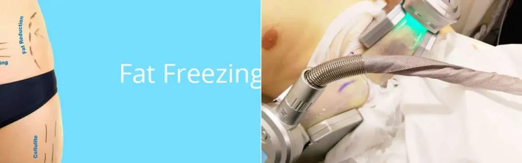 Fat freezing Tilbury on multiple areas of the body