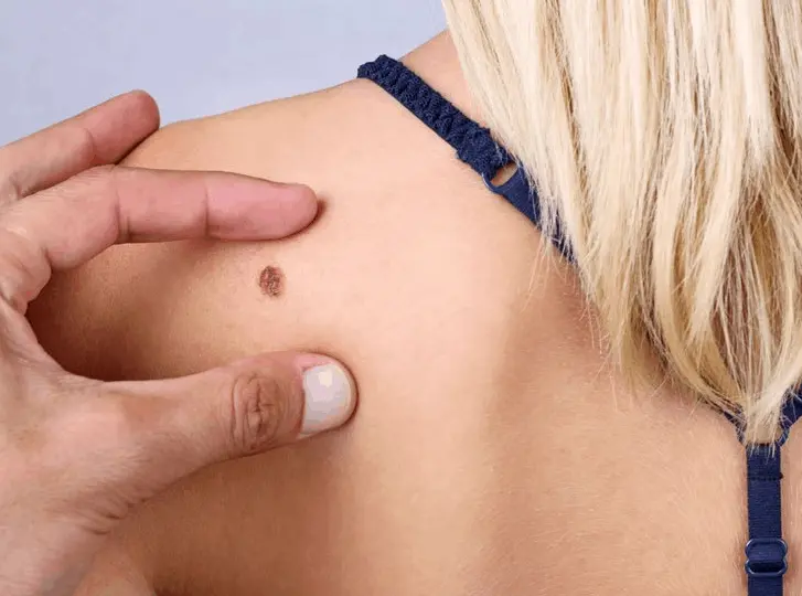 woman having mole removal Tilbury consultation before treatment.