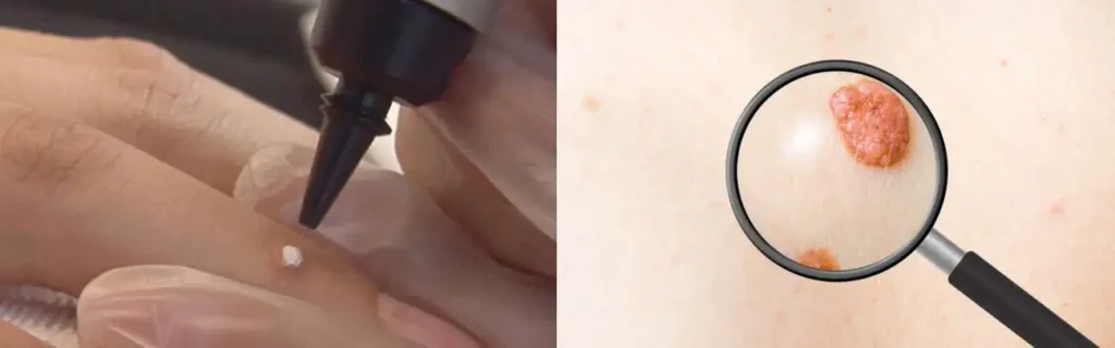 Cryopen for mole removal Tilbury - speak to our team today!