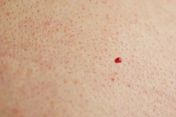 close up of a cherry angioma Tilbury
