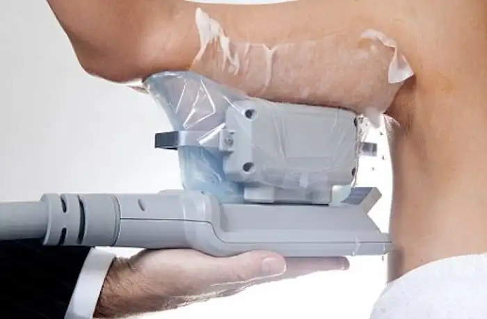 Picture of fat freezing Tilbury on the upper arms.