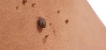 image of a skin tag Tilbury