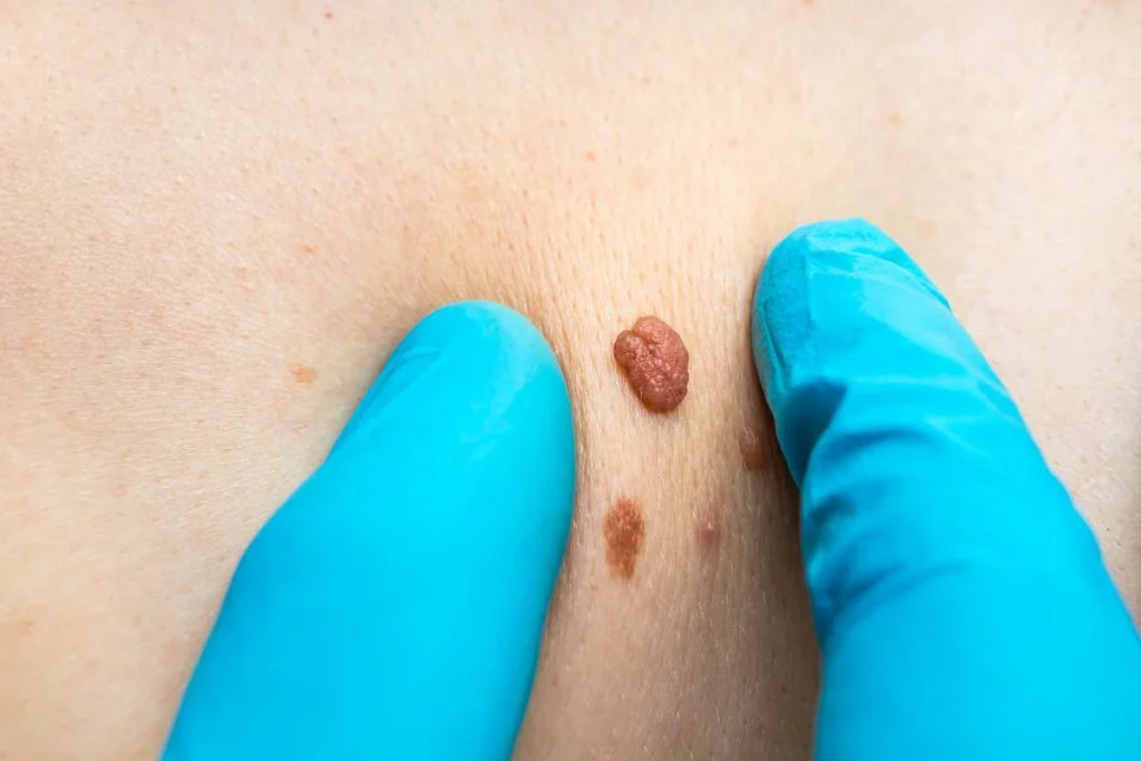 Consultant examining a skin tag Tilbury