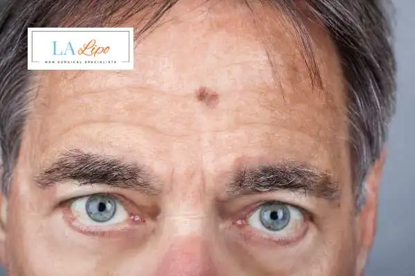 Solar Lentigo Removal Tilbury image of man with mark on his forehead