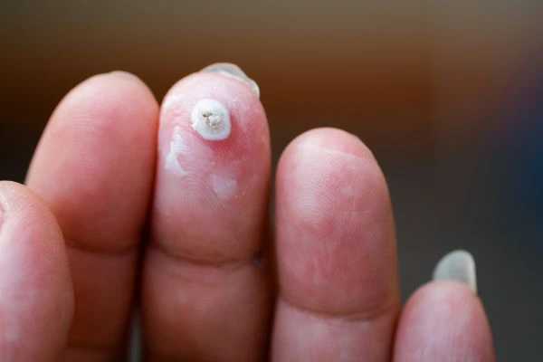 wart on person finger - cryotherapy to treat from LA LIPO Tilbury