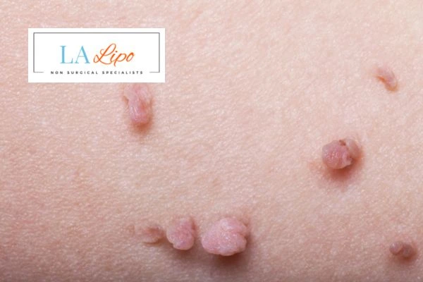 Does cryopen skin tag removal Tilbury hurt? Find out now call our team today!