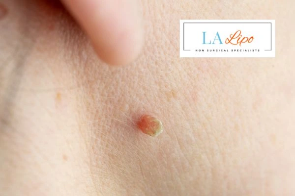 Book skin tag removal Tilbury today speak to our team now!