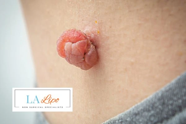 Interested in skin tag removal Tilbury? Concerned about the pain? Find out more today!