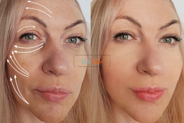 Morpheus 8 results Tilbury face lift.