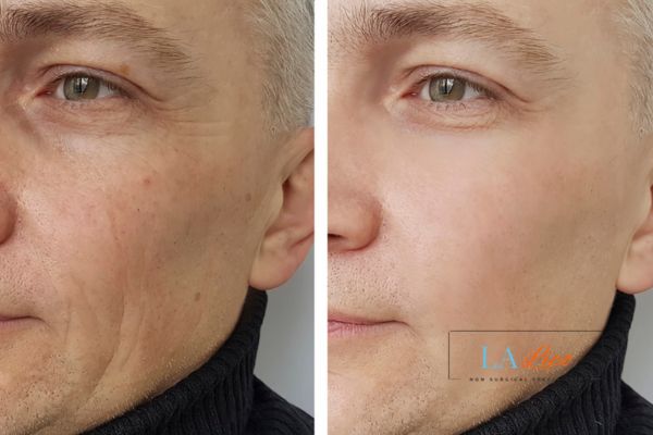 See the amazing results of Morpheus8 Treatment Tilbury!