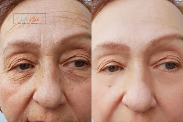 The powerful benefits of Morpheus8 Treatment Tilbury - Call Our team today!