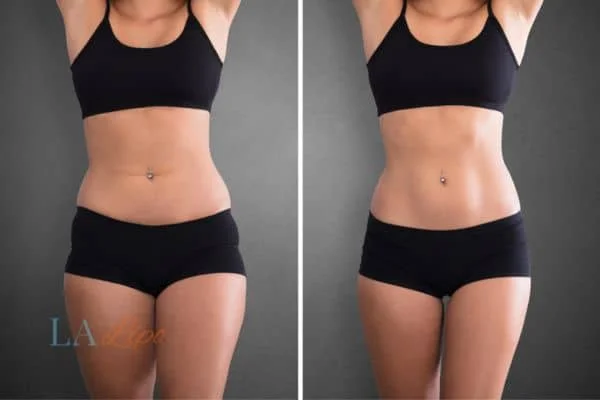before and after results of non-surgical treatment to help a woman's body image and mental health Tilbury