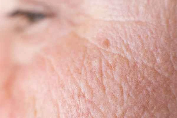 close up picture of a woman's face showing an age spot Tilbury