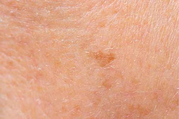 close up picture of age spots Tilbury