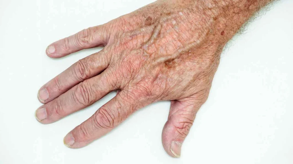 Male hand showing age spot Tilbury