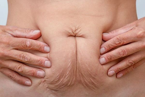 Should I Combine Diastasis Recti Treatment with Body Contouring for Better Results Tilbury?