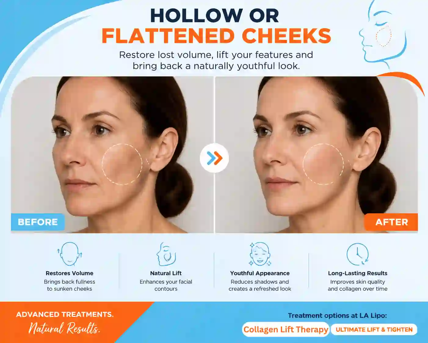 Sign #4: Hollow or Flattened Cheeks Tilbury
