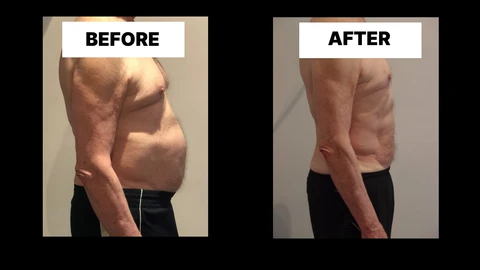 What Symptoms Can Diastasis Recti Cause in Men? Weak Core, Back Pain and Poor Posture Tilbury